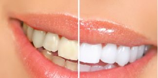 Como hacer un blanqueador dental